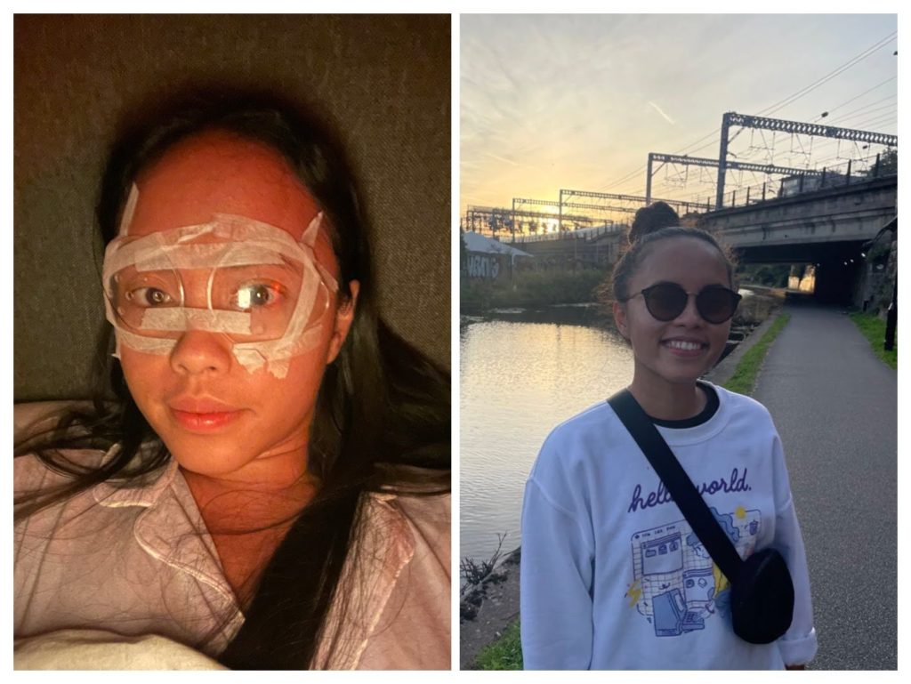 The days after my LASIK surgery: plastering eye shields to my face and sunglasses for weeks!